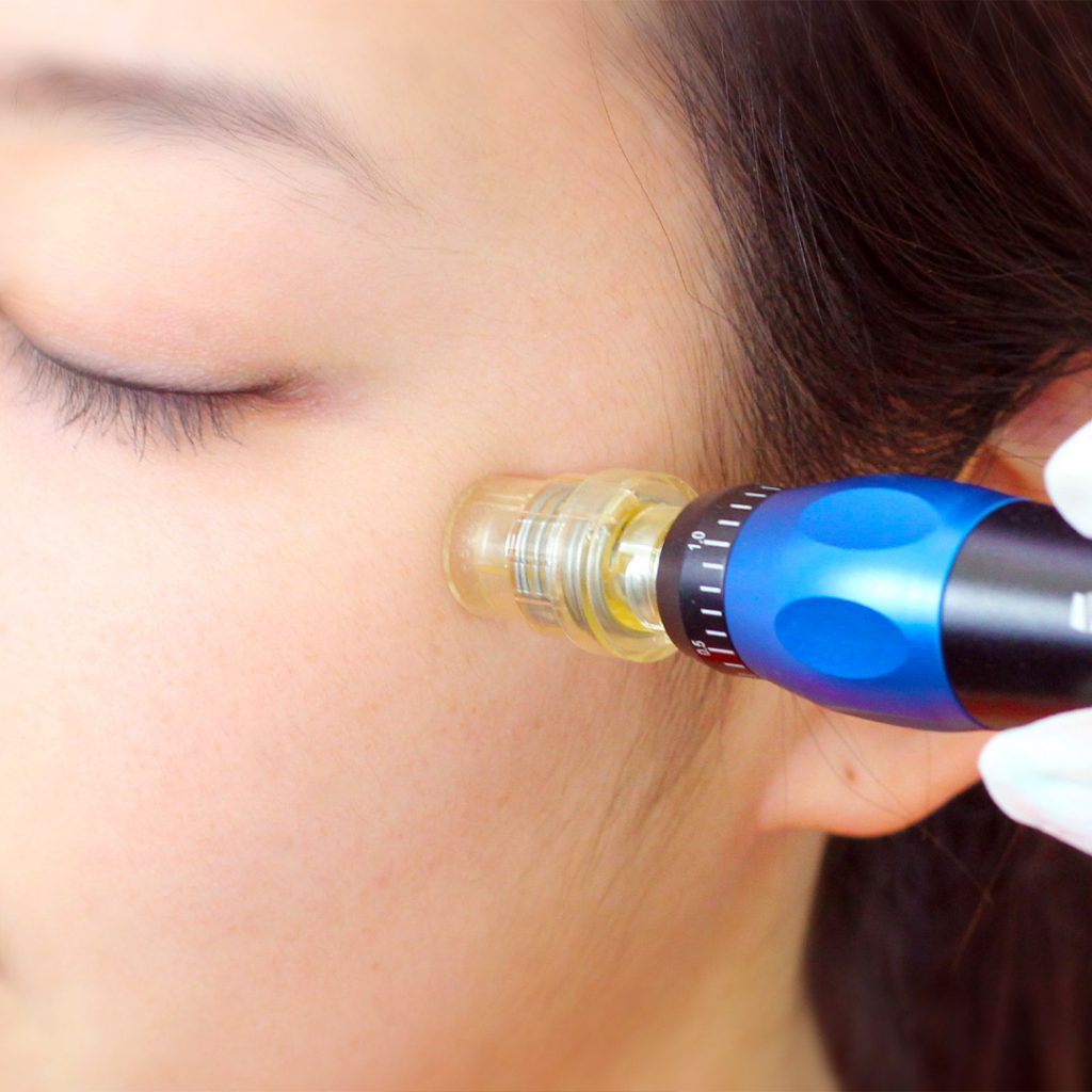 Dermapen TM, Anti Aging