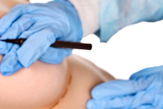 breast augmentation surgery