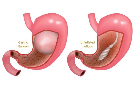 Введение желудочного баллона