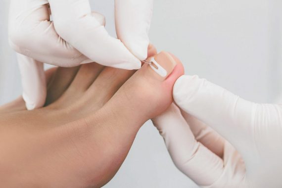 Вросший ноготь