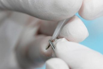 DHI methode - Haartransplantation