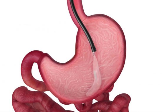 medworld-clGastric Balloon removalinic-obesity-Gastric-balloon-removal Gastric Balloon removal