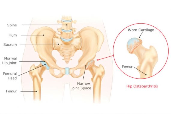Остеоартрит