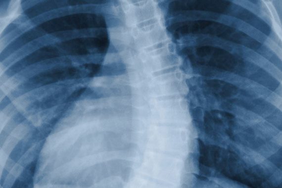 Scoliosis Treatment Scoliosis Treatment